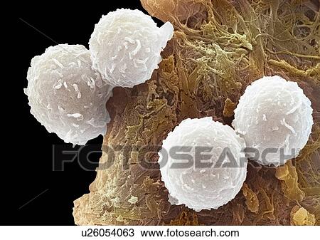 Stock Image - Leukaemia blood cells, SEM. Fotosearch