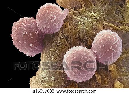 Stock Photo - Leukaemia blood cells, SEM. Fotosearch