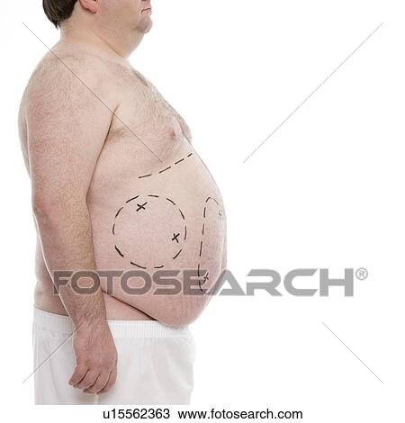 Stock Image - Liposuction. Fotosearch