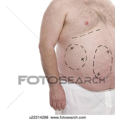 Stock Photo - Liposuction. Fotosearch