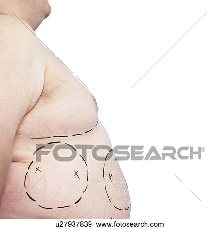 Liposuction View Large Photo Image Stock Photo - Liposuction. Fotosearch