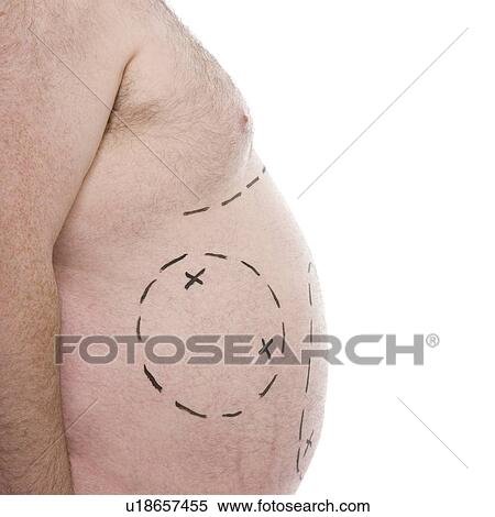 Stock Photography - Liposuction. Fotosearch