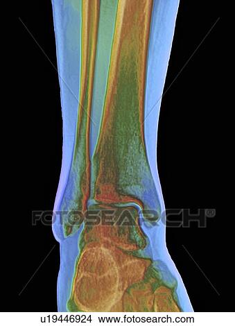 Picture - Normal ankle joint, X-ray. Fotosearch