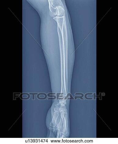 Normal elbow and wrist joints, X-ray View Large Photo Image Picture - Normal elbow and wrist joints, X-ray. Fotosearch