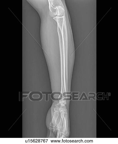 Normal elbow and wrist joints, X-ray View Large Photo Image Stock Photo - Normal elbow and wrist joints, X-ray. Fotosearch