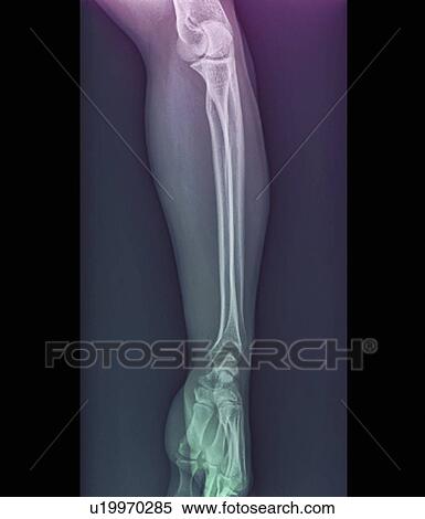 Normal elbow and wrist joints, X-ray View Large Photo Image Stock Photography - Normal elbow and wrist joints, X-ray. Fotosearch