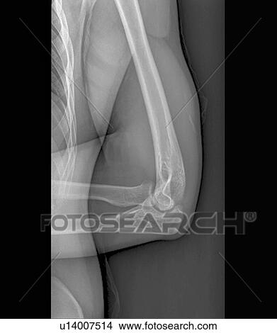 Normal elbow joint, X-ray View Large Photo Image Picture - Normal elbow joint, X-ray. Fotosearch