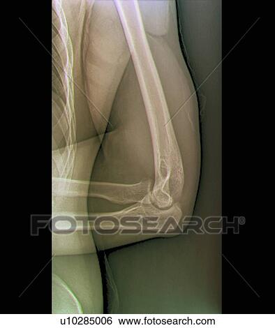 Normal elbow joint, X-ray View Large Photo Image Stock Photograph - Normal elbow joint, X-ray. Fotosearch