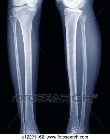 Normal lower legs, X-ray View Large Photo Image Stock Image - Normal lower legs, X-ray. Fotosearch