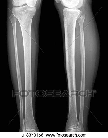 Normal lower legs, X-ray View Large Photo Image Stock Photograph - Normal lower legs, X-ray. Fotosearch