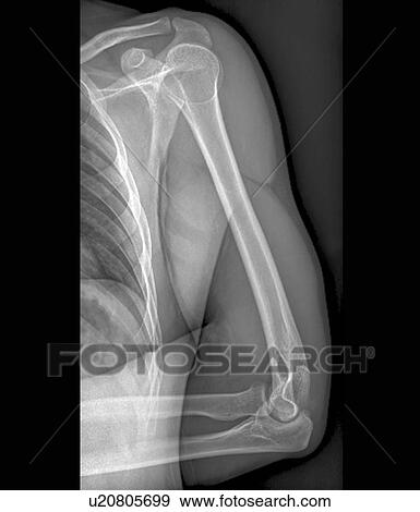 Normal shoulder and elbow joints, X-ray View Large Photo Image Stock Photo - Normal shoulder and elbow joints, X-ray. Fotosearch