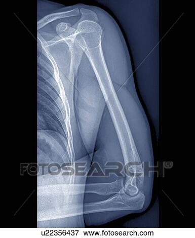 Stock Photo - Normal shoulder and elbow joints, X-ray. Fotosearch