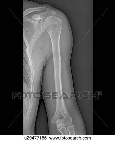 Normal shoulder and elbow joints, X-ray View Large Photo Image Stock Photograph - Normal shoulder and elbow joints, X-ray. Fotosearch