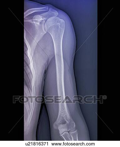 Stock Image - Normal shoulder joint, X-ray. Fotosearch
