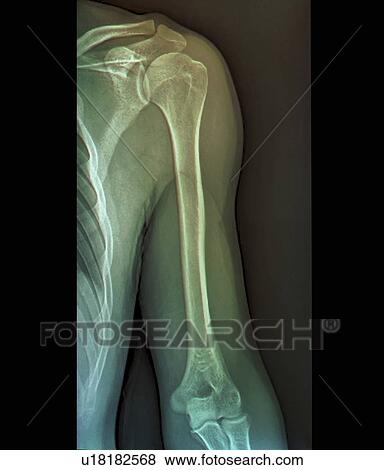 Normal shoulder joint, X-ray View Large Photo Image Stock Photo - Normal shoulder joint, X-ray. Fotosearch