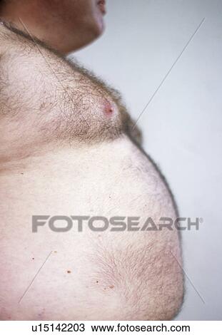 Obesity View Large Photo Image Stock Image - Obesity. Fotosearch