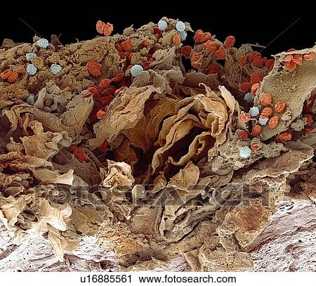 Stock Image - Pyoderma skin disease, SEM. Fotosearch