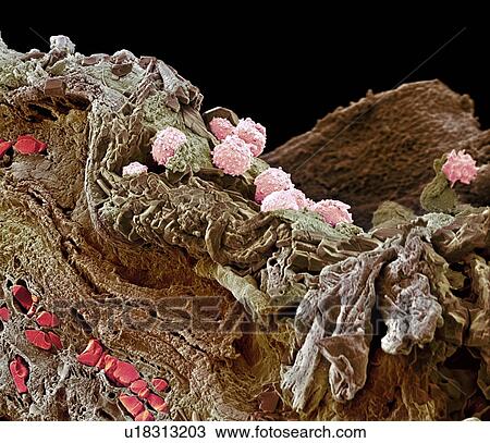 Pyoderma skin disease, SEM View Large Photo Image Stock Image - Pyoderma skin disease, SEM. Fotosearch