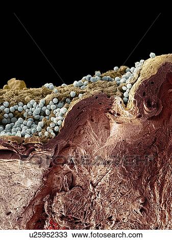 Stock Image - Pyoderma skin disease, SEM. Fotosearch