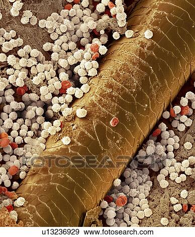 Pyoderma skin disease, SEM View Large Photo Image Stock Photo - Pyoderma skin disease, SEM. Fotosearch