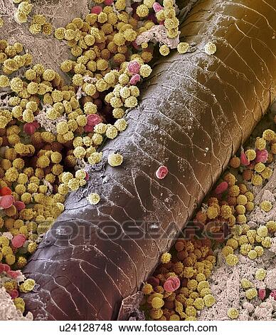 Stock Photo - Pyoderma skin disease, SEM. Fotosearch