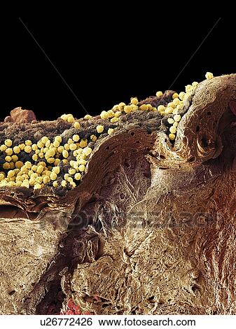 Stock Photograph - Pyoderma skin disease, SEM. Fotosearch