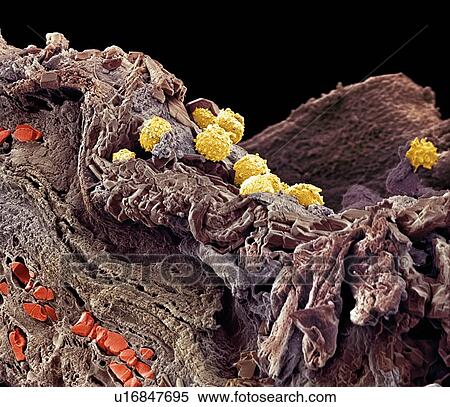 Stock Photography - Pyoderma skin disease, SEM. Fotosearch