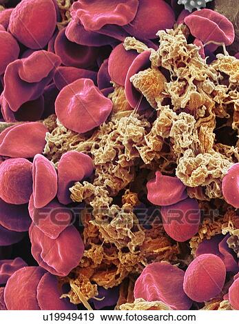 Stock Photo - Red blood cells and platelets, SEM. Fotosearch