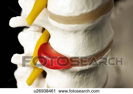 Slipped disc View Large Photo Image Stock Image - Slipped disc. Fotosearch