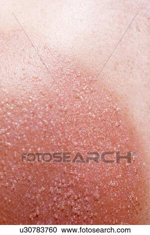 Stock Image - Sunburnt skin. Fotosearch
