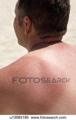 Stock Photography - Sunburnt skin. Fotosearch