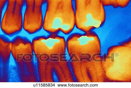 Picture - Teeth with fillings, X-ray. Fotosearch