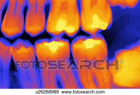 Stock Photo - Teeth with fillings, X-ray. Fotosearch