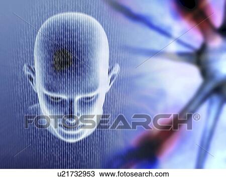 Stock Image - Alzheimer's disease. Fotosearch