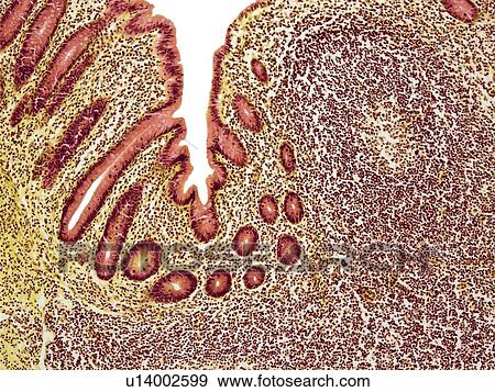 Stock Photo - Appendicitis, light micrograph. Fotosearch