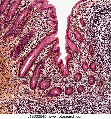 Stock Photography - Appendicitis, light micrograph. Fotosearch