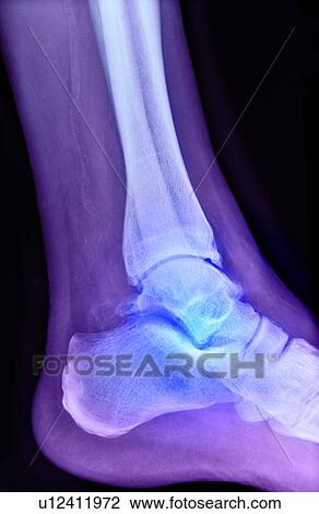 Stock Image - Arthritic ankle, X-ray. Fotosearch