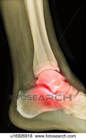 Arthritic ankle, X-ray View Large Photo Image Stock Photo - Arthritic ankle, X-ray. Fotosearch