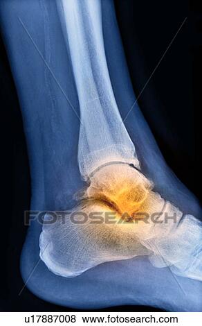 Arthritic ankle, X-ray View Large Photo Image Stock Photo - Arthritic ankle, X-ray. Fotosearch