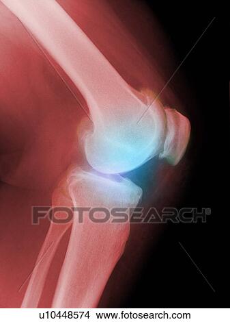 Arthritic knee, X-ray View Large Photo Image Picture - Arthritic knee, X-ray. Fotosearch