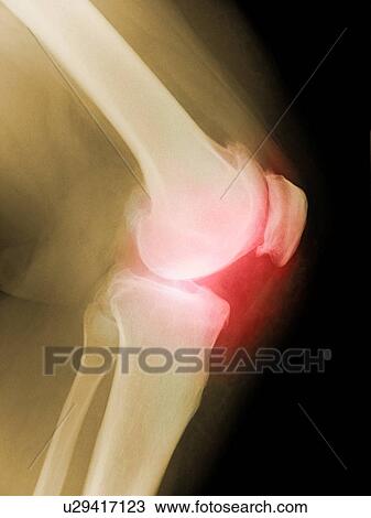 Arthritic knee, X-ray View Large Photo Image Stock Image - Arthritic knee, X-ray. Fotosearch
