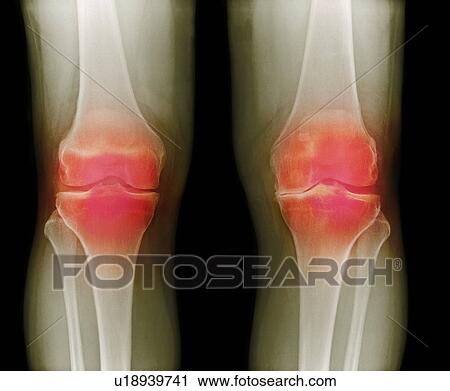 Arthritic knees, X-ray View Large Photo Image Stock Image - Arthritic knees, X-ray. Fotosearch