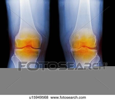 Stock Photo - Arthritic knees, X-ray. Fotosearch