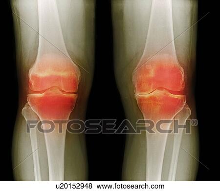Arthritic knees, X-ray View Large Photo Image Stock Photo - Arthritic knees, X-ray. Fotosearch