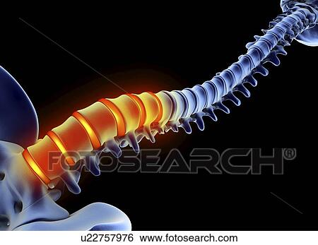 Stock Photograph - Back pain, computer artwork. Fotosearch