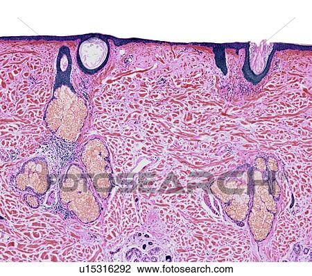 Stock Image - Bald scalp, light micrograph. Fotosearch