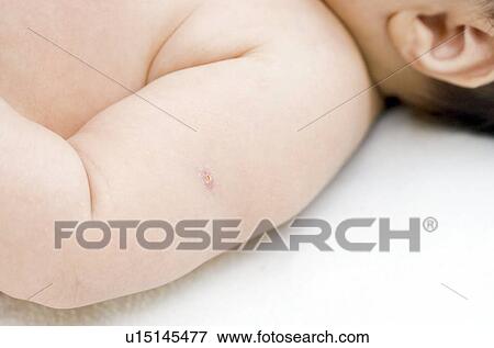 Stock Photo - BCG vaccination scar. Fotosearch