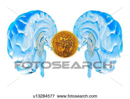 Stock Photo - Brain cancer, conceptual artwork. Fotosearch