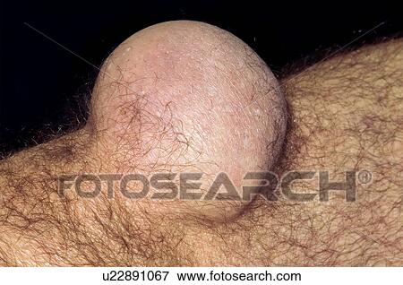 Stock Photo - Bursitis of the knee. Fotosearch