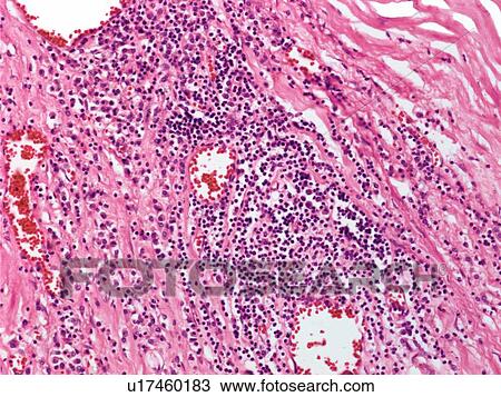 Cardiovascular syphilis, light micrograph View Large Photo Image Stock Image - Cardiovascular syphilis, light micrograph. Fotosearch